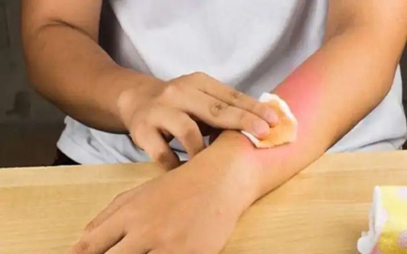 Sơ cứu bị bỏng và tầm quan trọng của việc đảm bảo sự phục hồi hoàn toàn