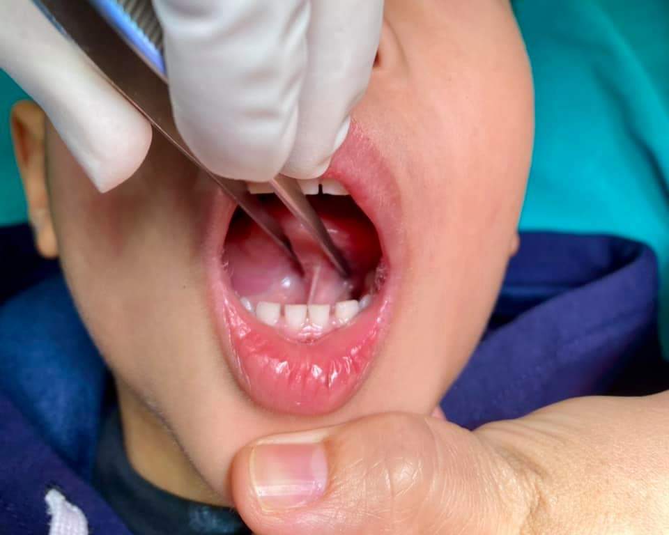 Dính thắng lưỡi trẻ em những điều cha mẹ cần biết – Hội phẫu thuật nhi