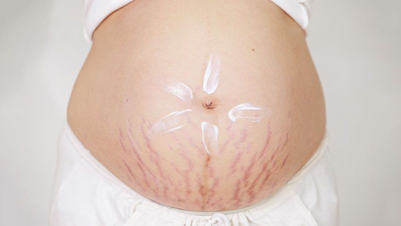 Nguyên nhân khiến da bị rạn khi mang bầu