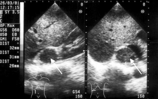 Siêu âm tuyến thượng thận – GS. Phạm Minh Thông Bạch Mai – Vietnamese  Radiology Materials
