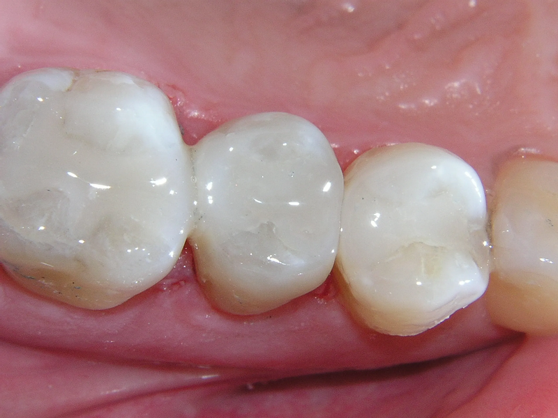Trám răng tạm thời: phương pháp chăm sóc răng hiệu quả