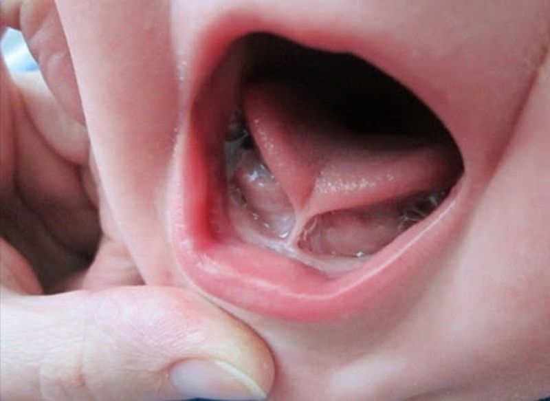Phẫu thuật cắt dính thắng lưỡi: giải pháp đơn giản cho trẻ