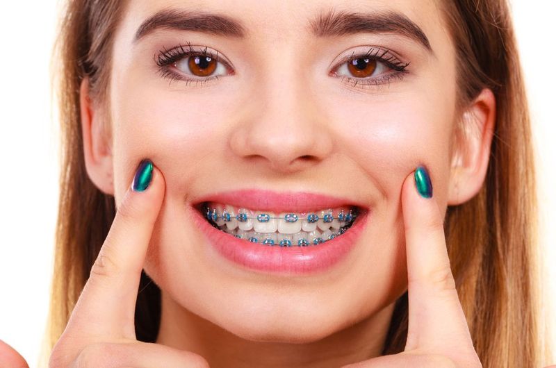 Tuổi 25 có thể niềng răng được không?