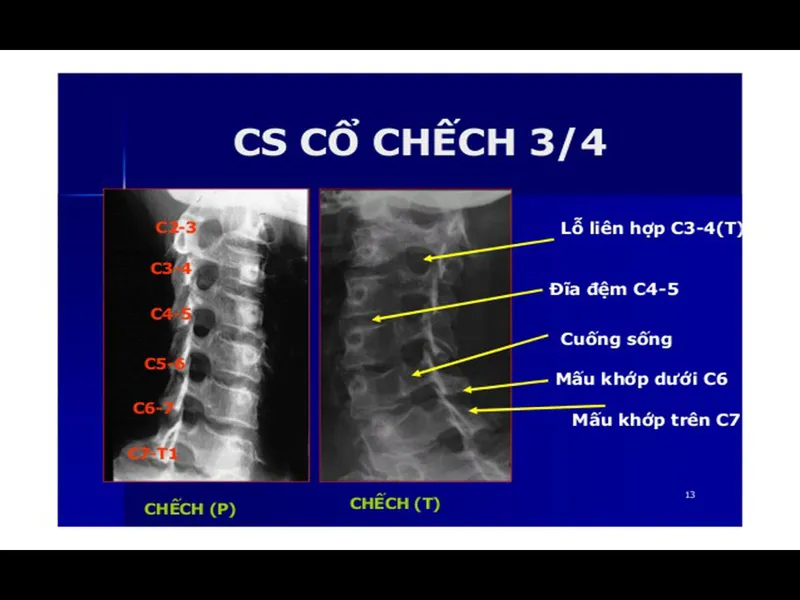 Quy trình chụp x quang cột sống cổ chếch 3/4 và tầm quan trọng trong chẩn đoán bệnh lý cột sống cổ