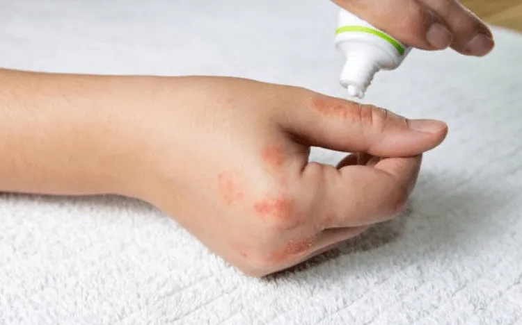 Viêm da tiếp xúc do kiến ba khoang: nguyên nhân và triệu chứng