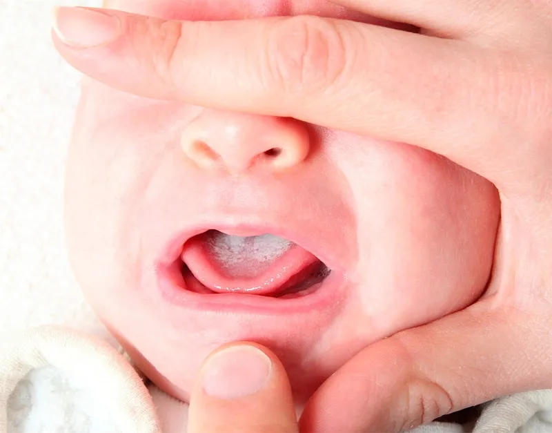 Từa lượi ở trẻ nhỏ: đừng dạo trạng bất cứ bí quyết dân gian nào, nghiên cứu khoa học khuyến cáo