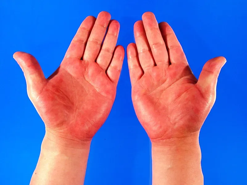 Các dấu hiệu bàn tay son có thể là cảnh báo bệnh gan?