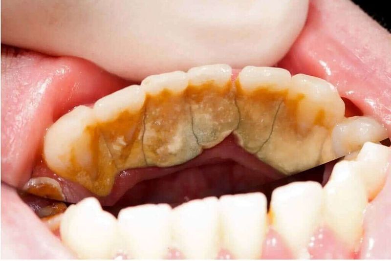 Cao răng: nguyên nhân, phân loại, và cách loại bỏ