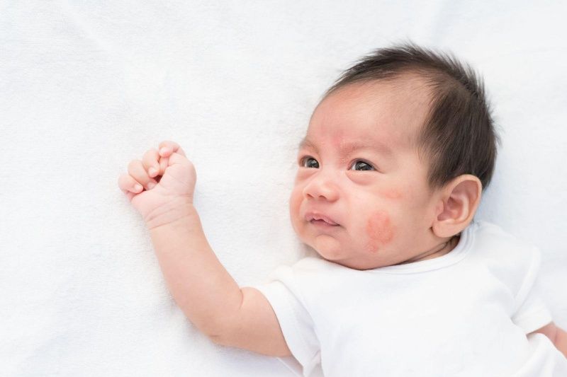 Dị ứng đạm sữa bò: nguyên nhân, triệu chứng và phòng ngừa