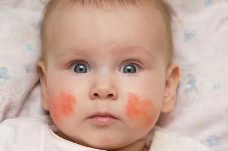Chàm sữa ở má - cách trị và chăm sóc trẻ bị chàm