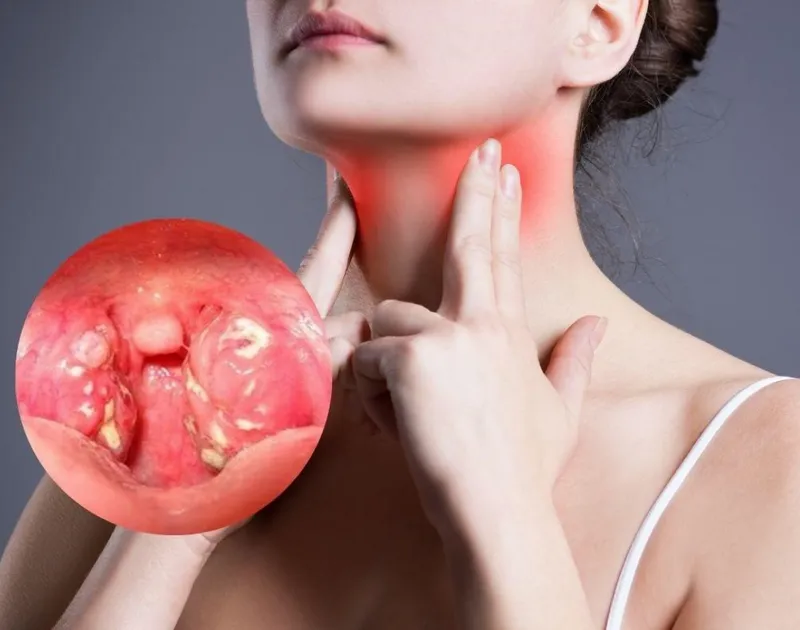 Viêm mũi họng: nguyên nhân, triệu chứng và cách điều trị