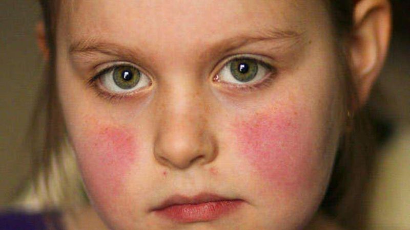 Xét nghiệm anti ds dna và vai trò của nó trong chẩn đoán lupus ban đỏ hệ thống