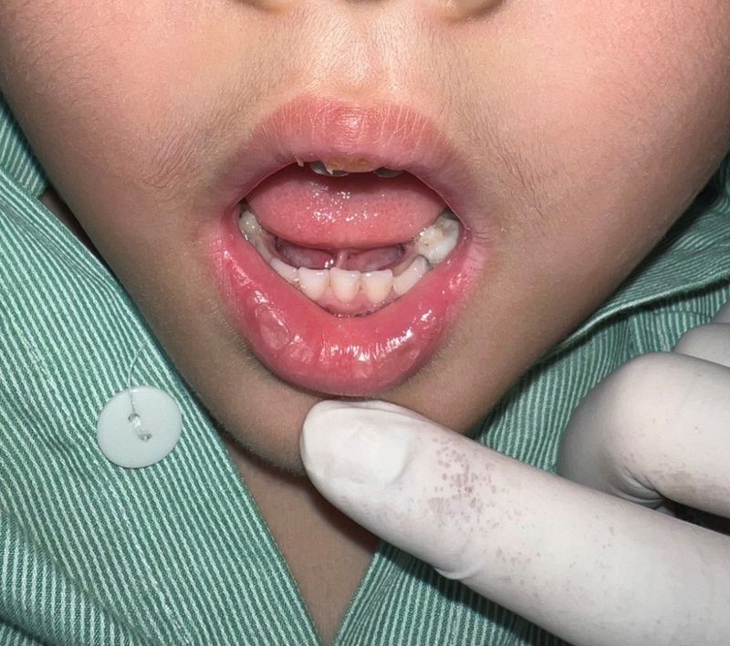 Dính thắng lưỡi có di truyền không và ảnh hưởng gì đến sức khỏe?