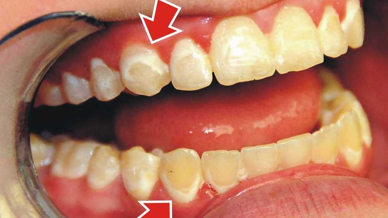 Hỏng men răng: khám phá, nguyên nhân, triệu chứng và cách xử lý
