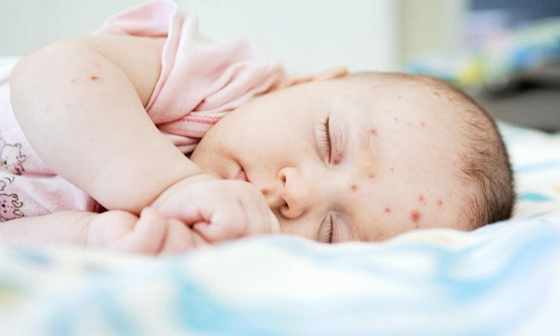 Nhiễm trùng da ở trẻ sơ sinh: nguyên nhân, biểu hiện và cách điều trị