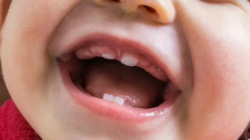 Phanh môi thấp ở trẻ: nguyên nhân và cách điều trị