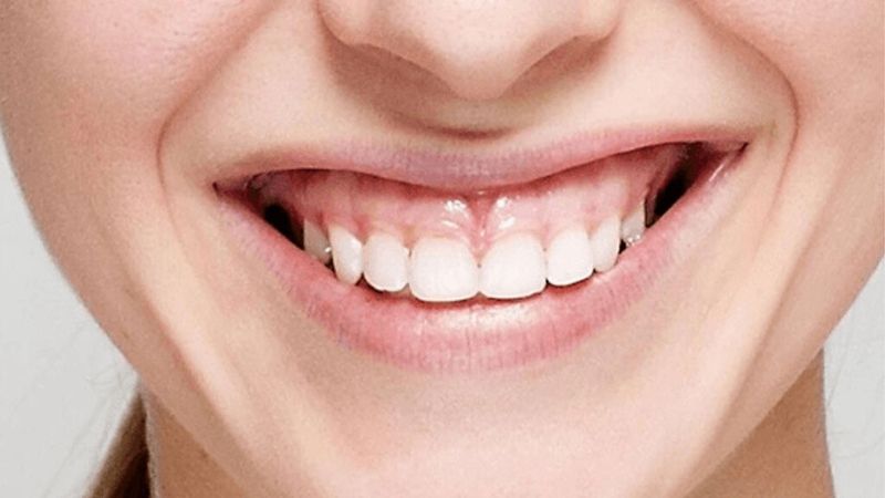 Điều trị cười hở lợi: phương pháp và lợi ích