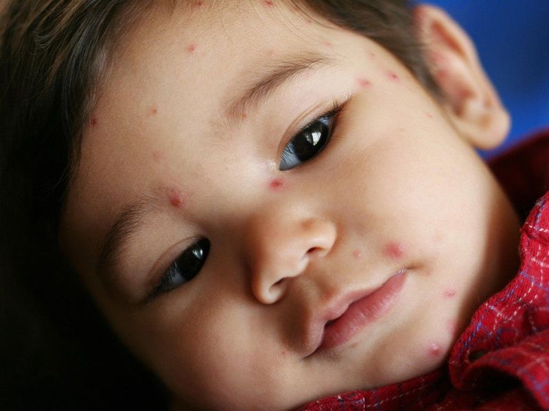 Bệnh thủy đậu ở trẻ em: nguyên nhân, triệu chứng, và cách chữa trị