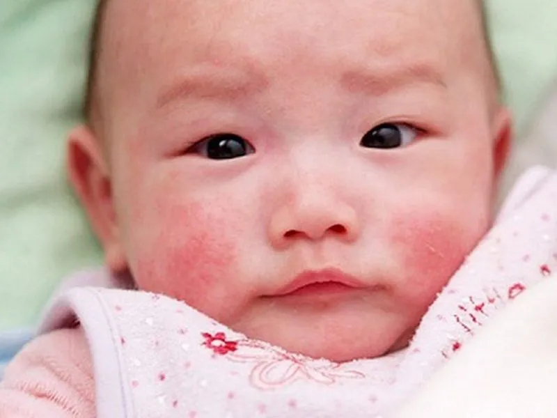 Bệnh lupus ban đỏ ở trẻ: lưu ý và chăm sóc trong mùa dịch covid-19