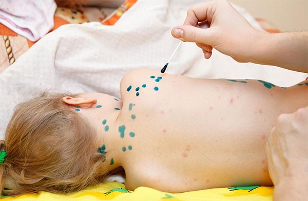 KHÔNG CHỦ QUAN VỚI DẤU HIỆU VÀ BIẾN CHỨNG CỦA BỆNH THỦY ĐẬU