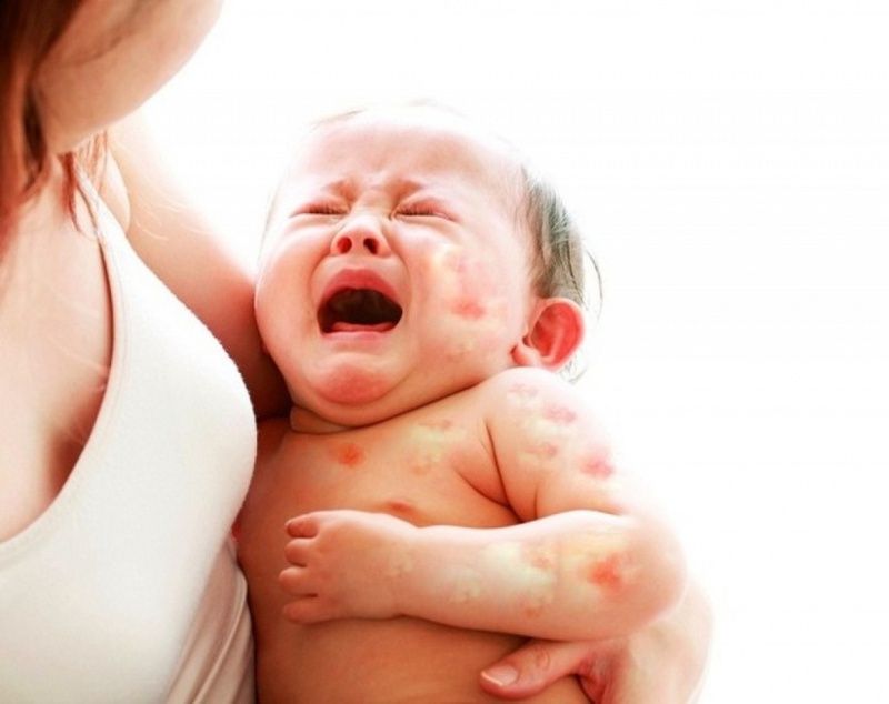 Bệnh viêm da dị ứng ở trẻ em: triệu chứng, cách điều trị và nguyên nhân