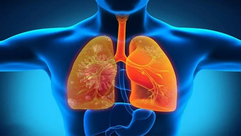 Chẩn đoán viêm phổi: triệu chứng, xét nghiệm và phương pháp điều trị