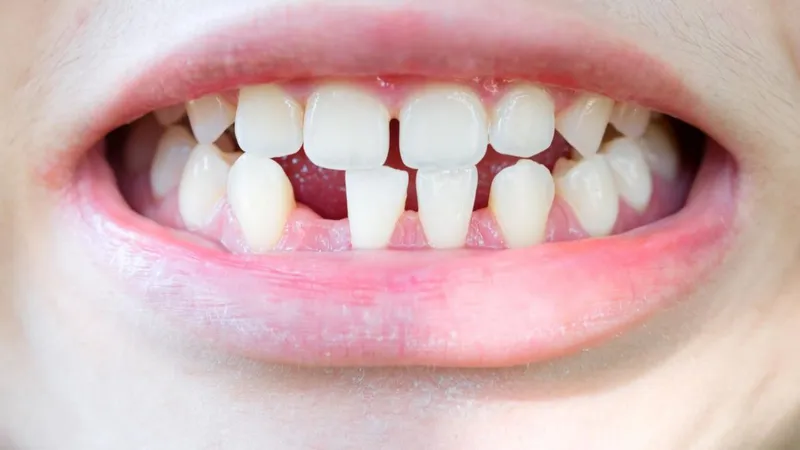 Tình trạng răng nhỏ: kiến thức cần biết