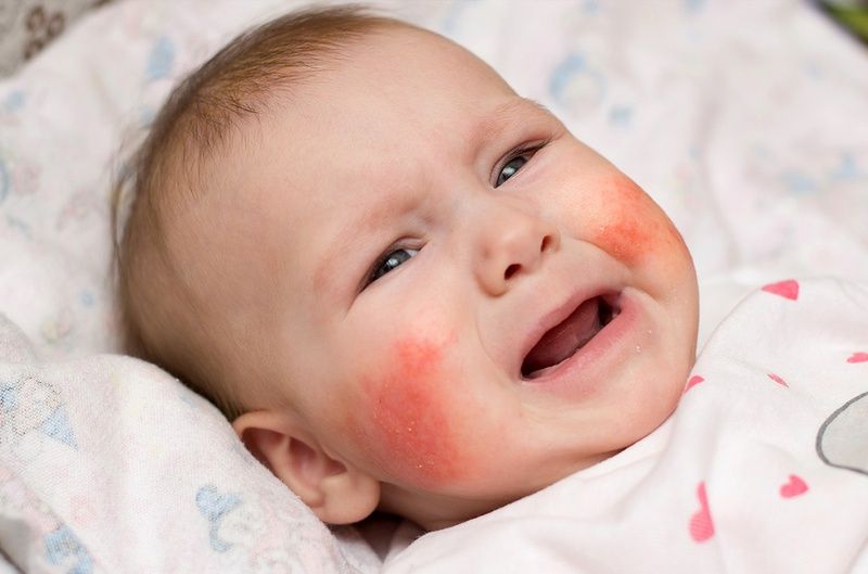 Bệnh dị ứng ở trẻ em và vai trò của hệ thống miễn dịch