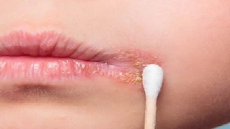 Herpes môi: bệnh do virus hsv, triệu chứng và phác đồ điều trị
