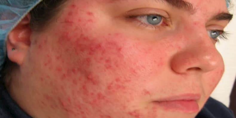 Cách Điều Trị Demodex Khỏi Đỏ Mặt Nhanh Và Hiệu Quả