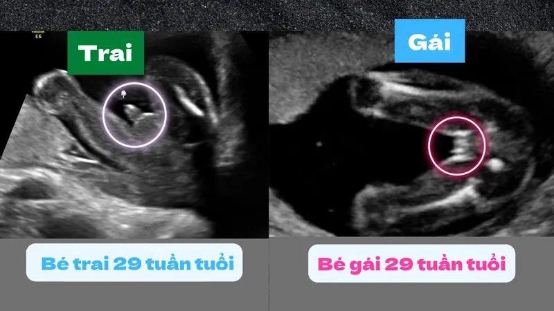 Dự đoán giới tính thai nhi bằng siêu âm: hướng dẫn chi tiết