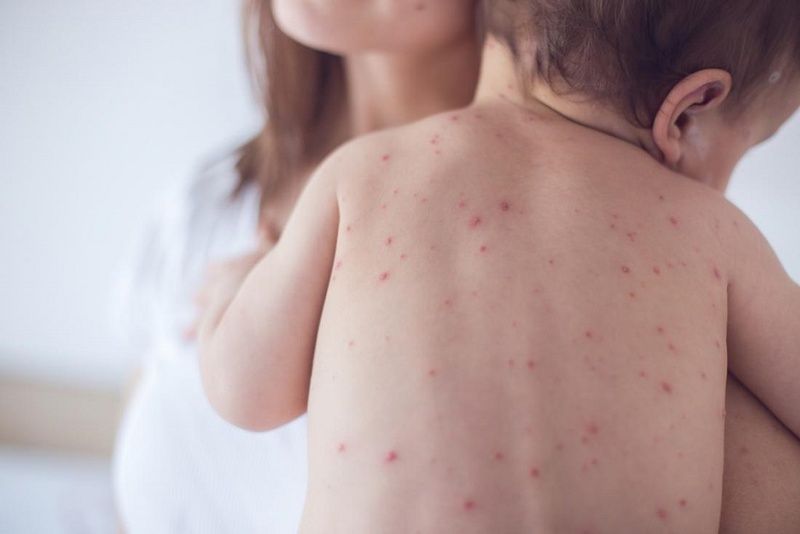 Nhận biết và chăm sóc trẻ bị sởi: triệu chứng và hướng dẫn chăm sóc