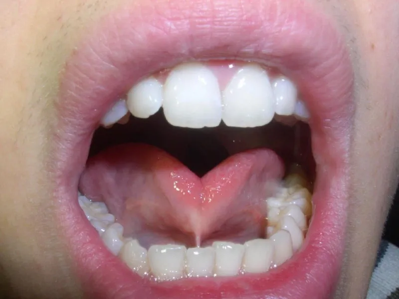Dính thắng lưỡi ở trẻ nhỏ: những dấu hiệu và cách điều trị