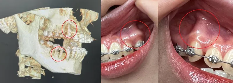Bật chân răng khi niềng răng: nguyên nhân, dấu hiệu và cách xử lý