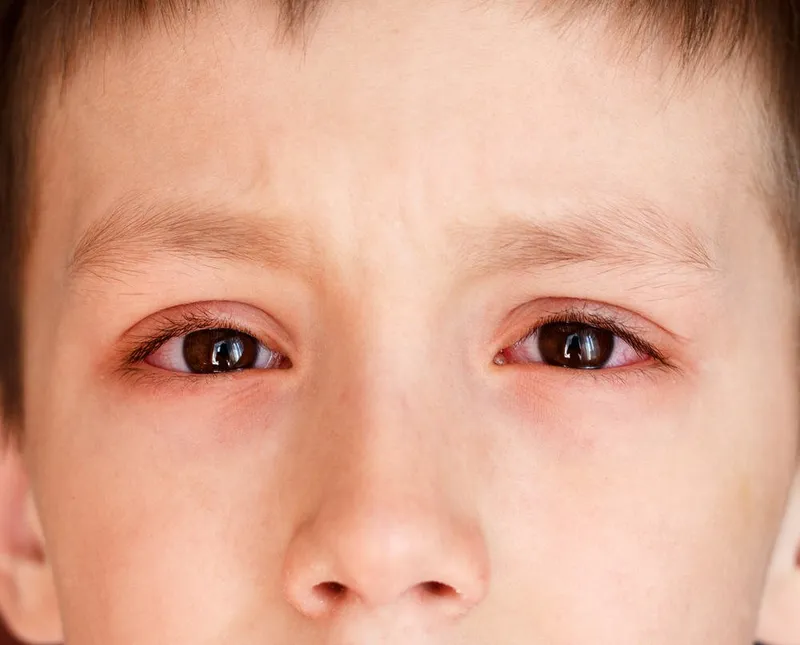 Làm sao để bé ngừng hành động dụi mắt?