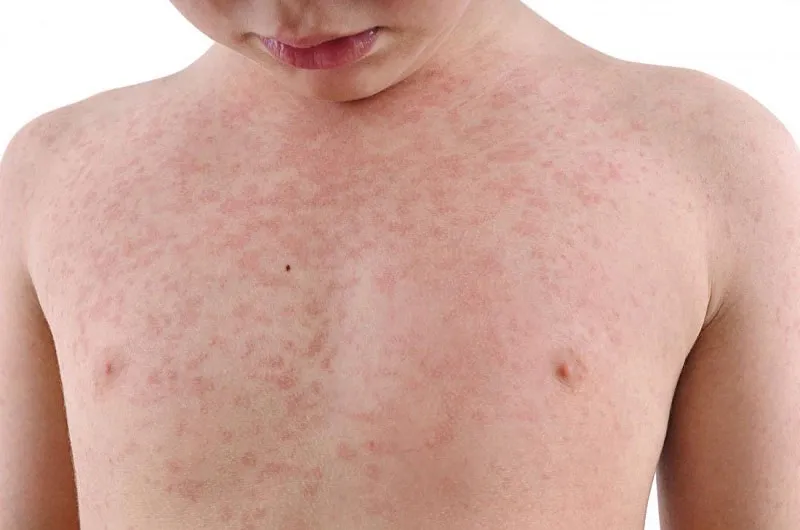 Sốt phát ban ở trẻ nhỏ: cách chăm sóc và điều trị hiệu quả