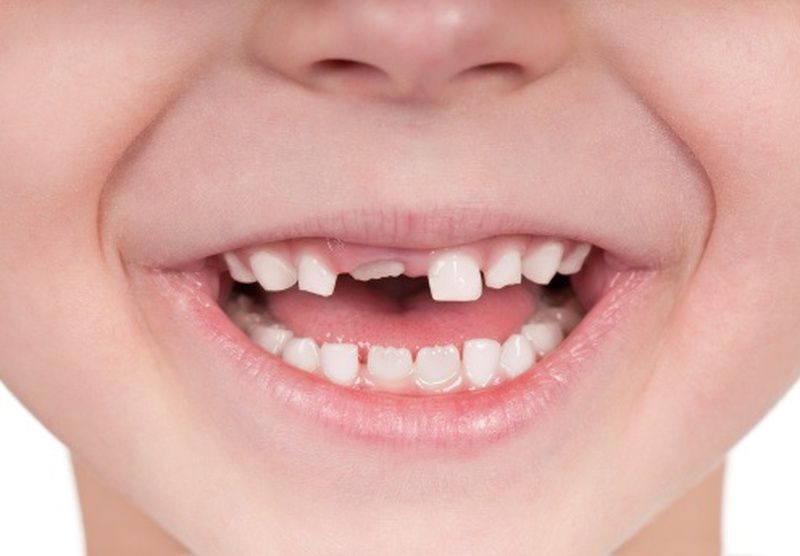 Bí quyết thay răng sữa cho trẻ: số lượng và thời gian thay răng