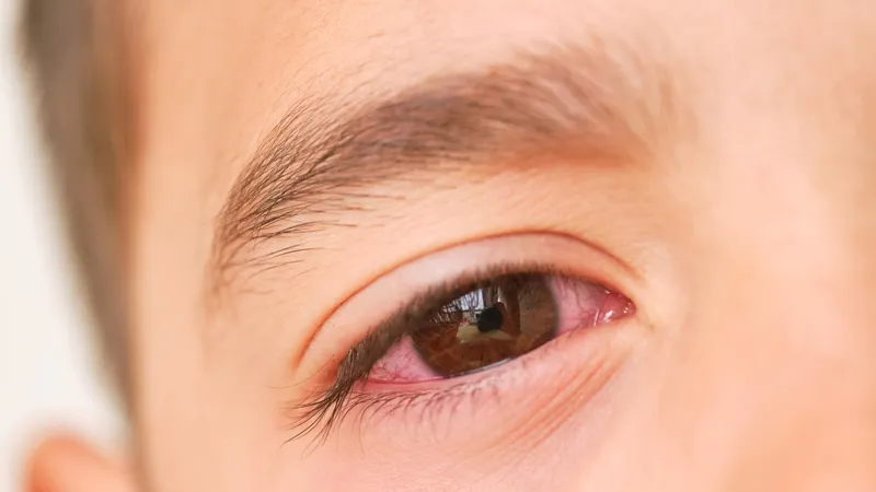 Đau mắt đỏ kèm sốt ở trẻ: dấu hiệu, chăm sóc và điều trị