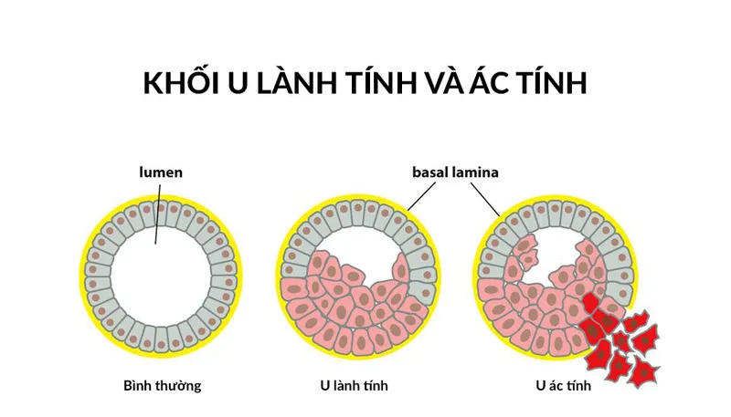 Sinh thiết đường mật qua da dưới x quang tăng sáng