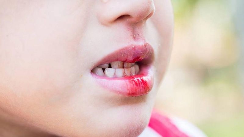 Phương pháp sơ cứu và phòng ngừa khi bé bị đứt dây thắng môi trên