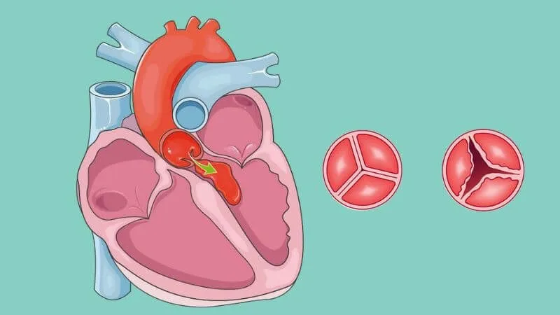 Phẫu thuật nội soi thay van tim là kỹ thuật tiên tiến giúp bảo vệ toàn vẹn xương ức cho người bệnh 