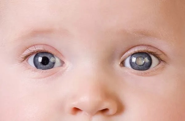Điều trị đục thủy tinh thể bẩm sinh | Kiến thức nhãn khoa