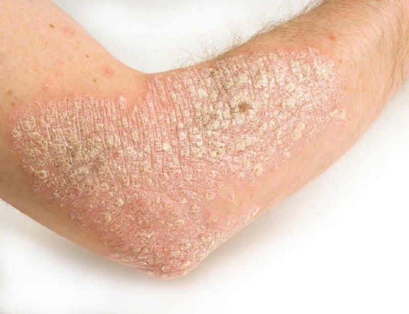 Bệnh vảy nến ở trẻ em: triệu chứng, điều trị và các phương pháp chăm sóc