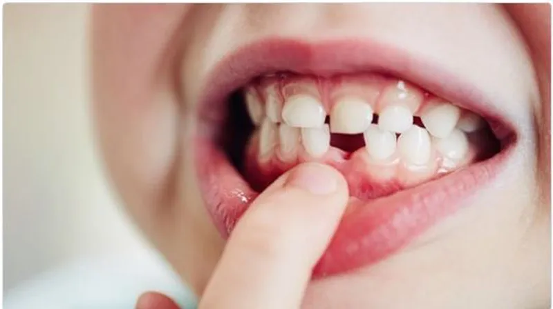 Nhổ răng sữa còn chân: nguy hiểm và cách khắc phục