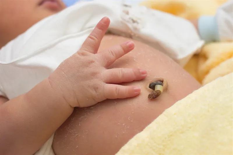 Thoát vị rốn ở trẻ sơ sinh: nguy hiểm và cách điều trị