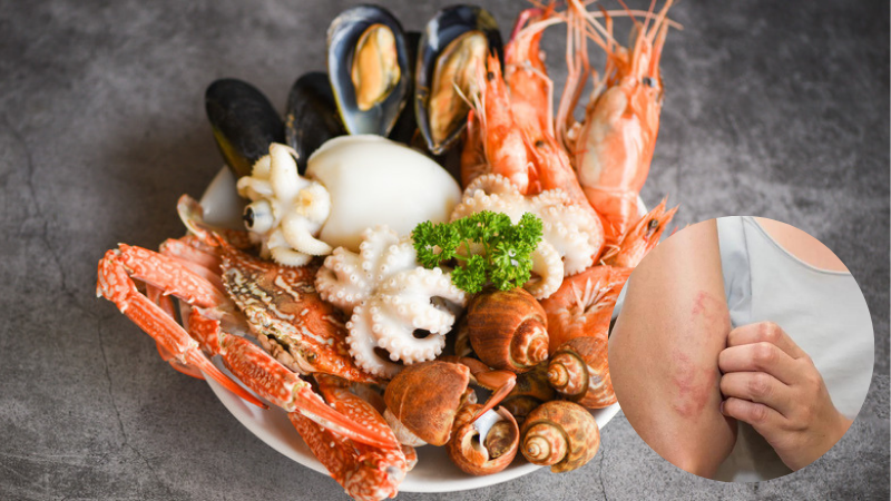Dị ứng động vật có vỏ: triệu chứng, nguyên nhân và cách phòng ngừa
