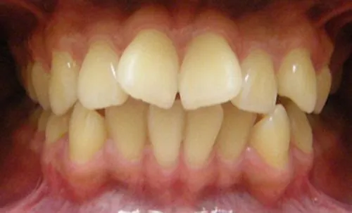 Tìm hiểu về răng cánh bướm và phương pháp khắc phục