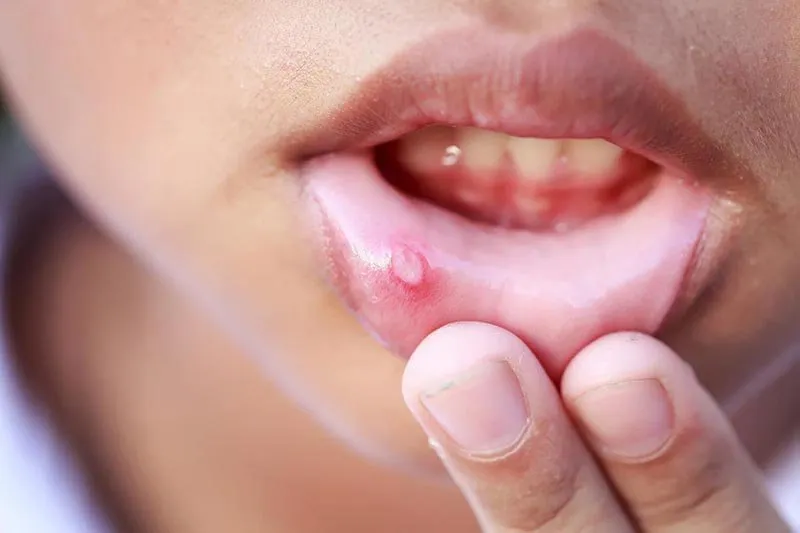 Nấm miệng và nhiệt miệng: nguyên nhân, triệu chứng và cách chăm sóc