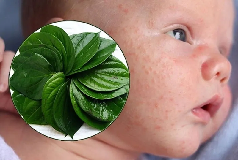 Cách chữa chàm sữa cho bé bằng lá trầu không: hiệu quả và an toàn