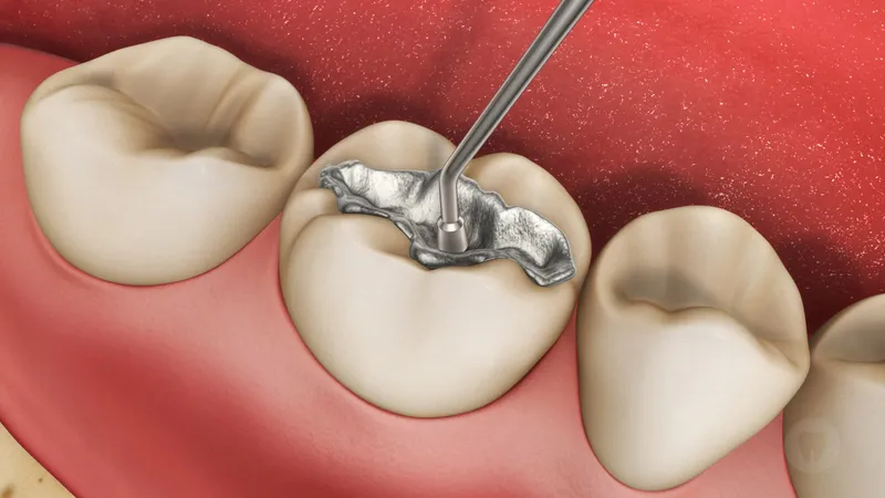 Trám răng sâu - phương pháp hiệu quả để bảo vệ răng miệng